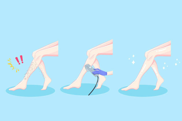 使用光子脫毛儀會(huì)讓毛孔變大嗎?(圖3) 脫毛儀器生產(chǎn)廠家