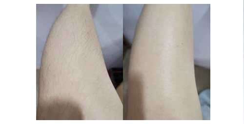 如何擺脫體毛濃密的困擾？體毛濃密女孩過來看看(圖2)