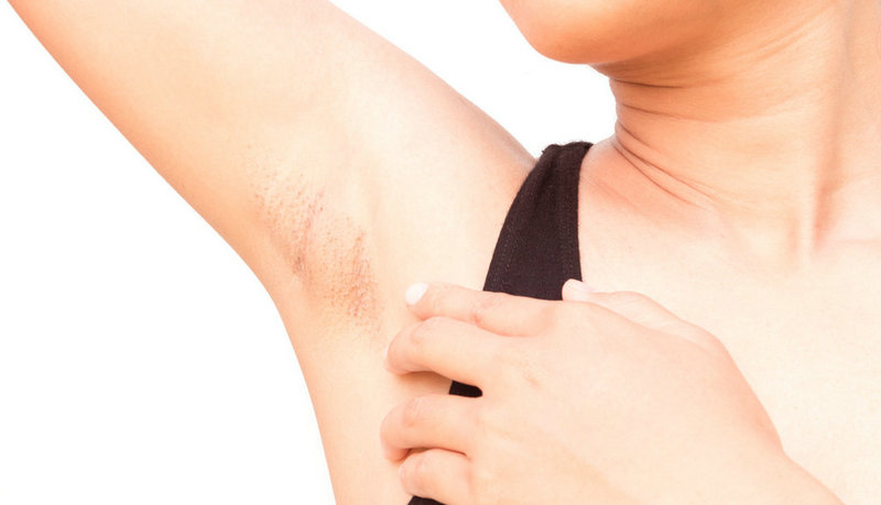 去腋毛會不會引起狐臭?有什么直接聯系嗎?(圖2) 去腋毛會不會引起狐臭?有什么直接聯系嗎?(圖2)